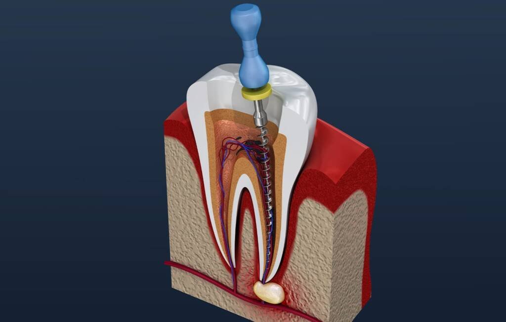 Root Canal Treatments