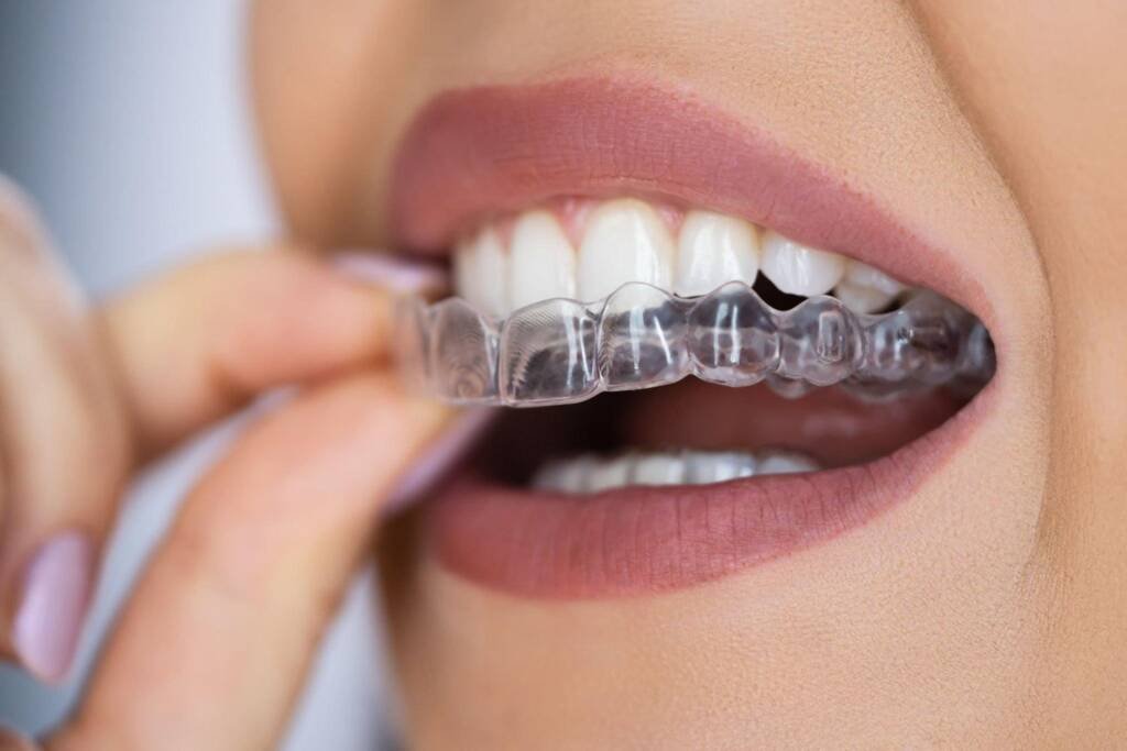 Invisalign Provider