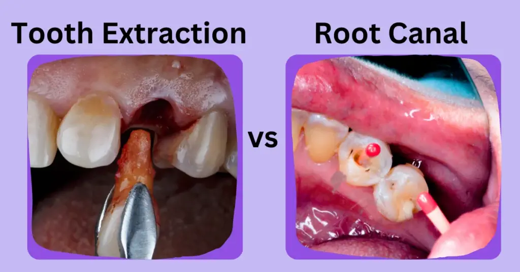 Tooth Extraction