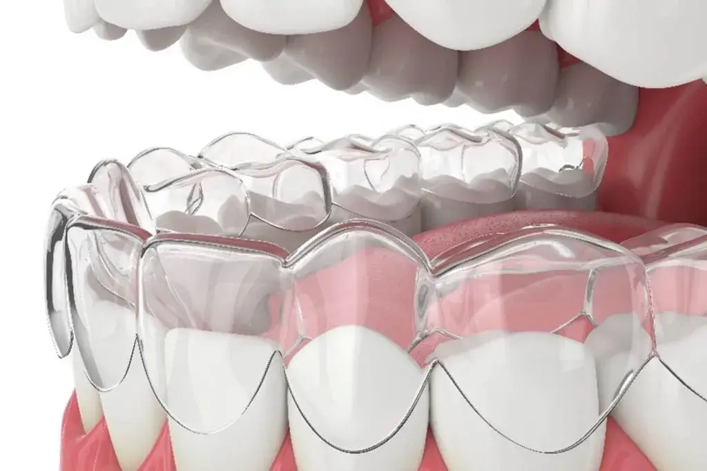 Clear Aligners