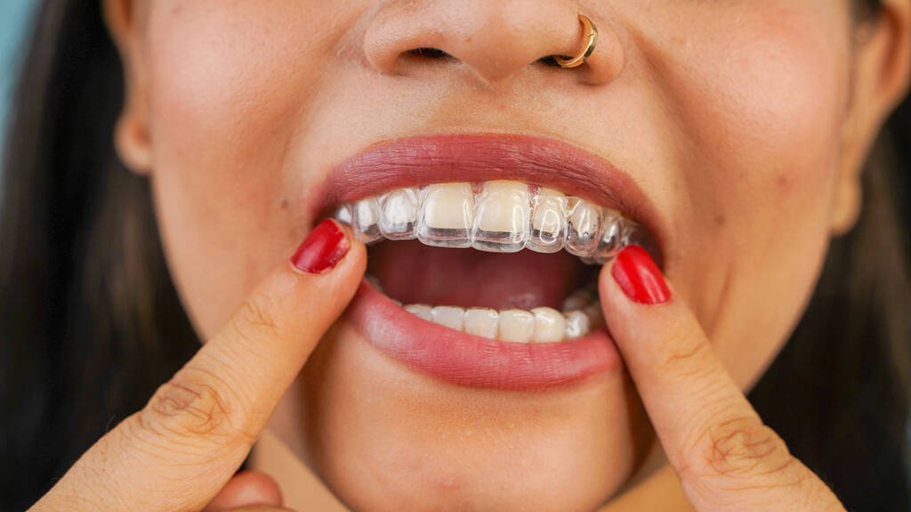 Invisalign Aligners