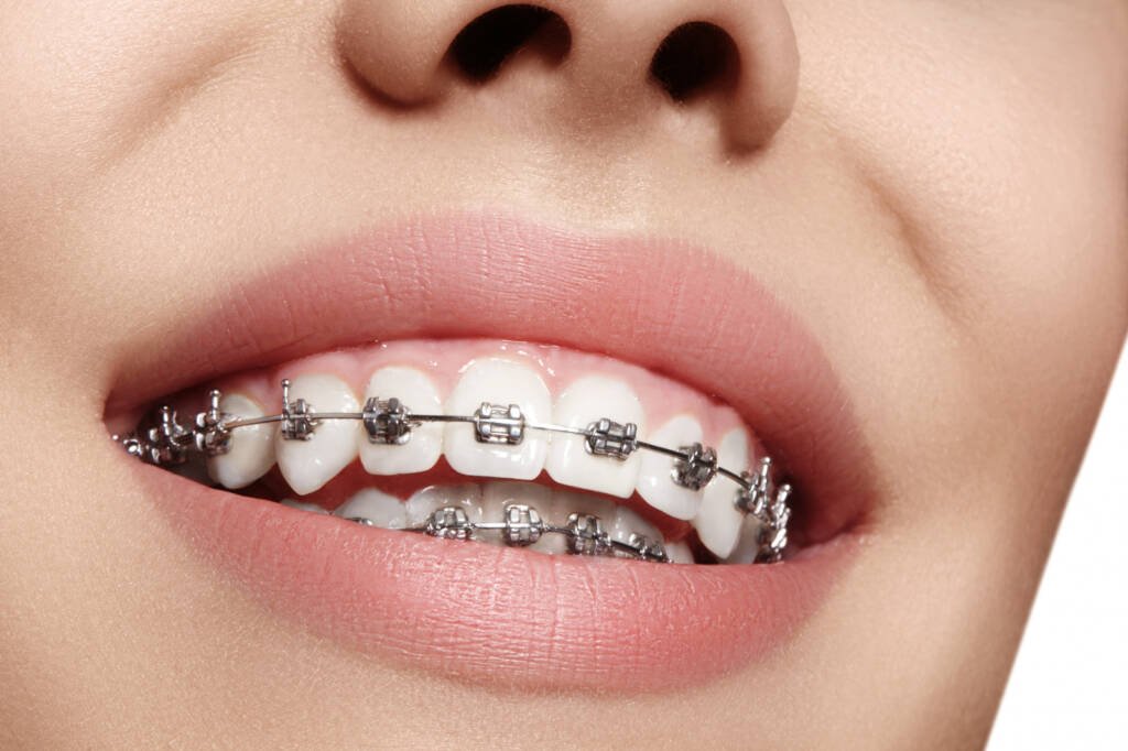Best Orthodontist in Bangalore