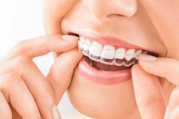 Clear Aligners in Bangalore
