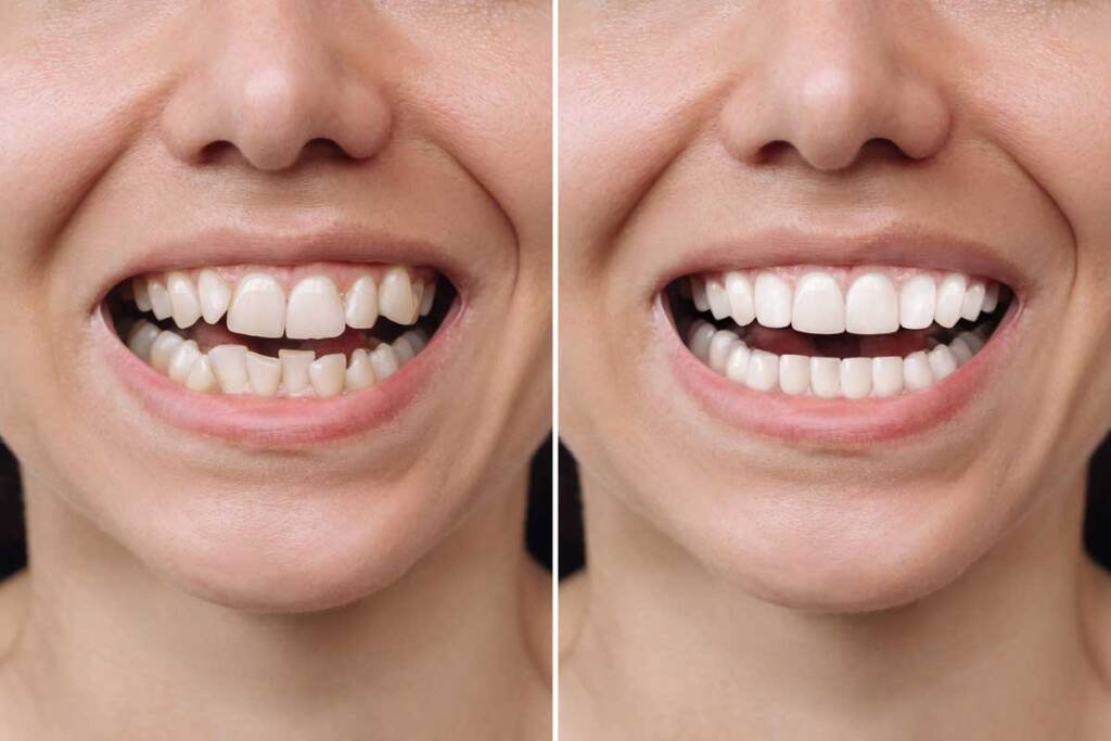Best Invisalign