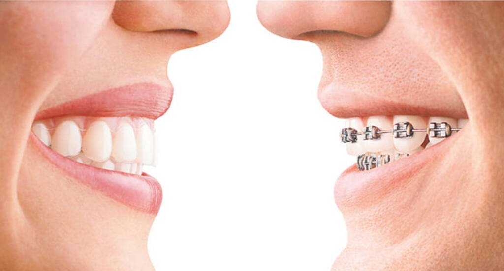 Dental Braces vs Invisalign
