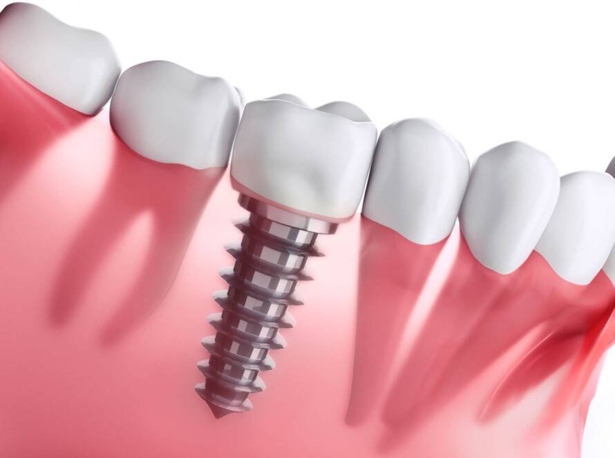 dental implants