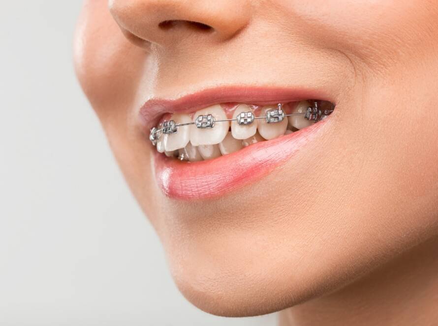 Invisalign® vs. Dental Braces
