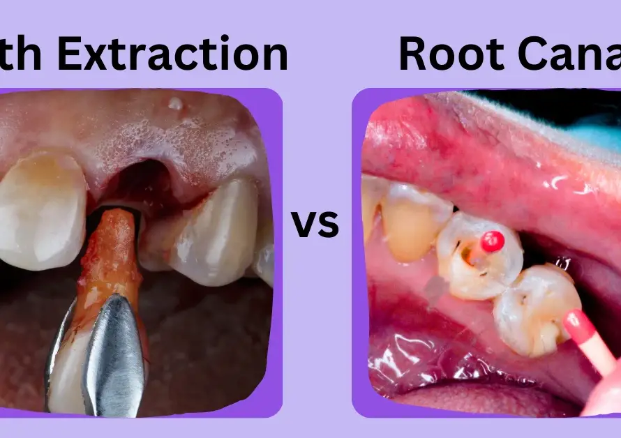 Tooth Extraction
