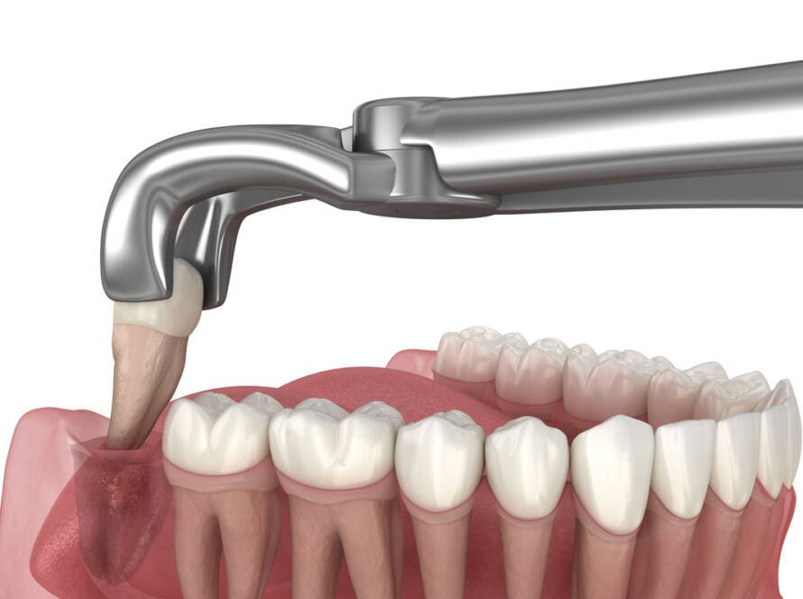 Wisdom Teeth Removal