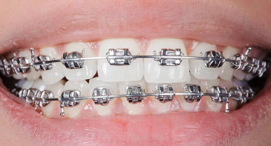Braces