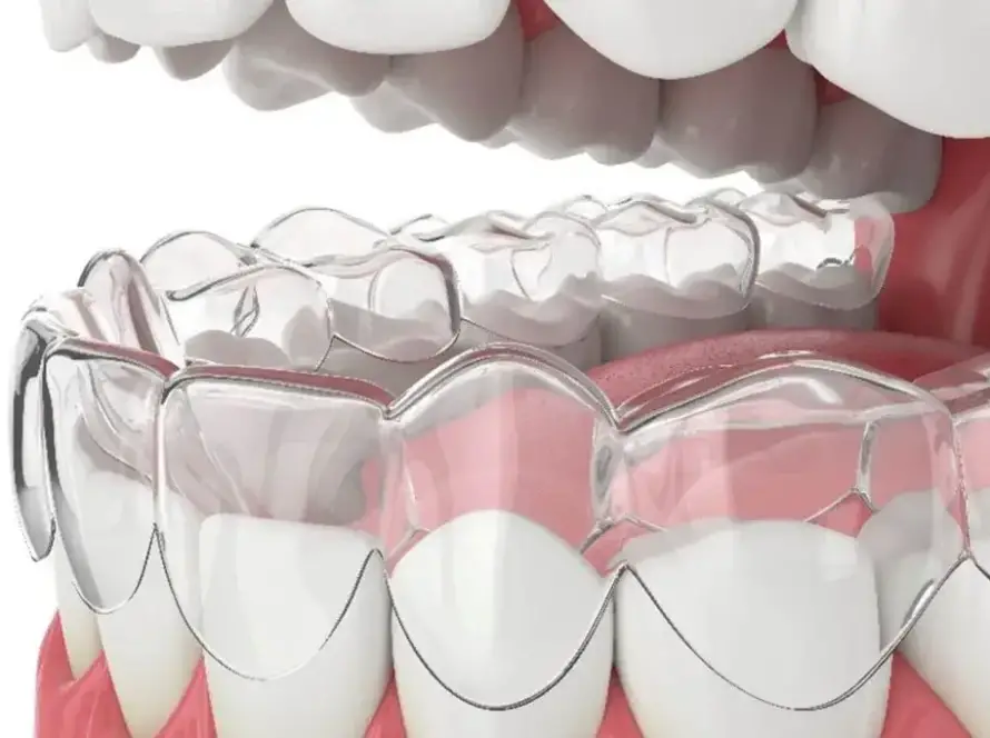 Clear Aligners