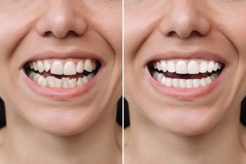 Invisalign vs. Braces