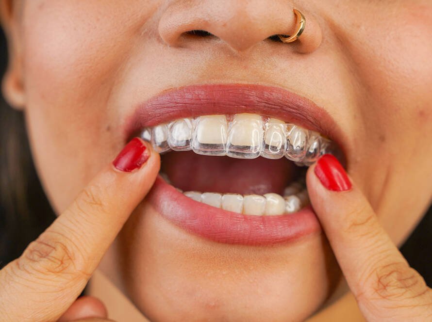 Invisalign Aligners