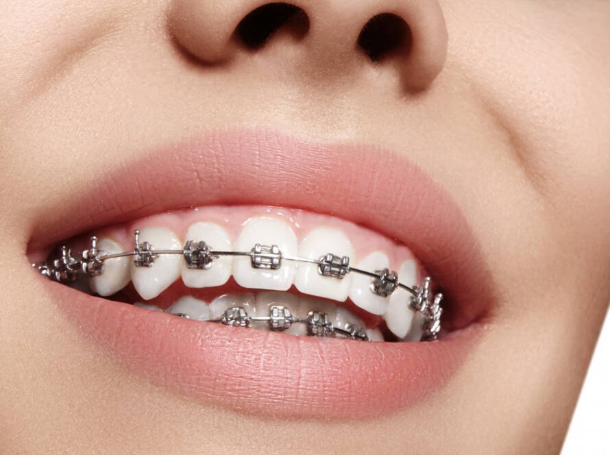 Best Orthodontist in Bangalore