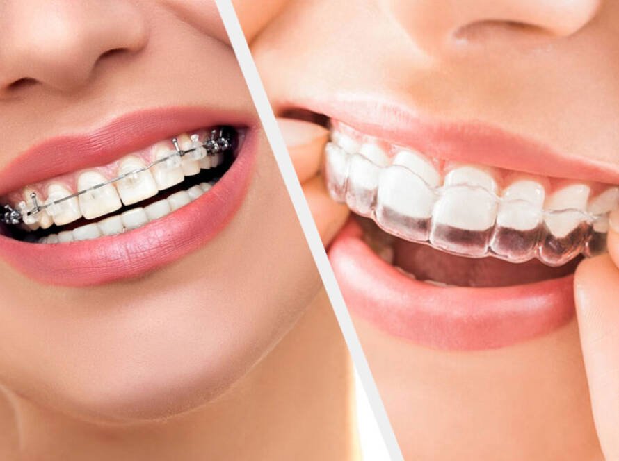 Invisalign & Braces