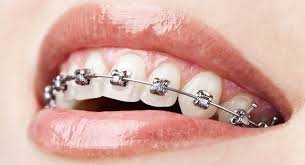 Dental Braces