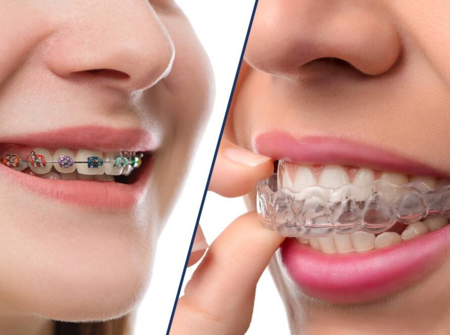 Braces and Invisalign