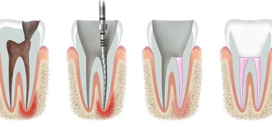 Root Canal Treatment
