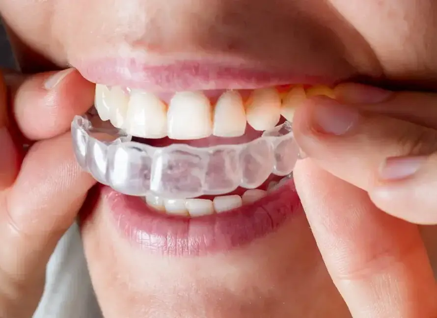 Invisalign Aligners