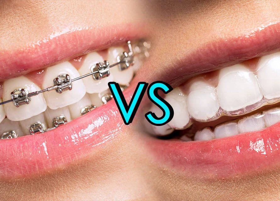 Invisalign vs Braces