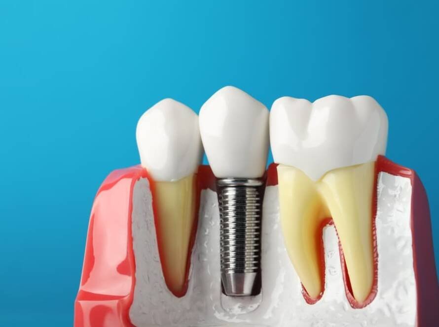 Dental Implants