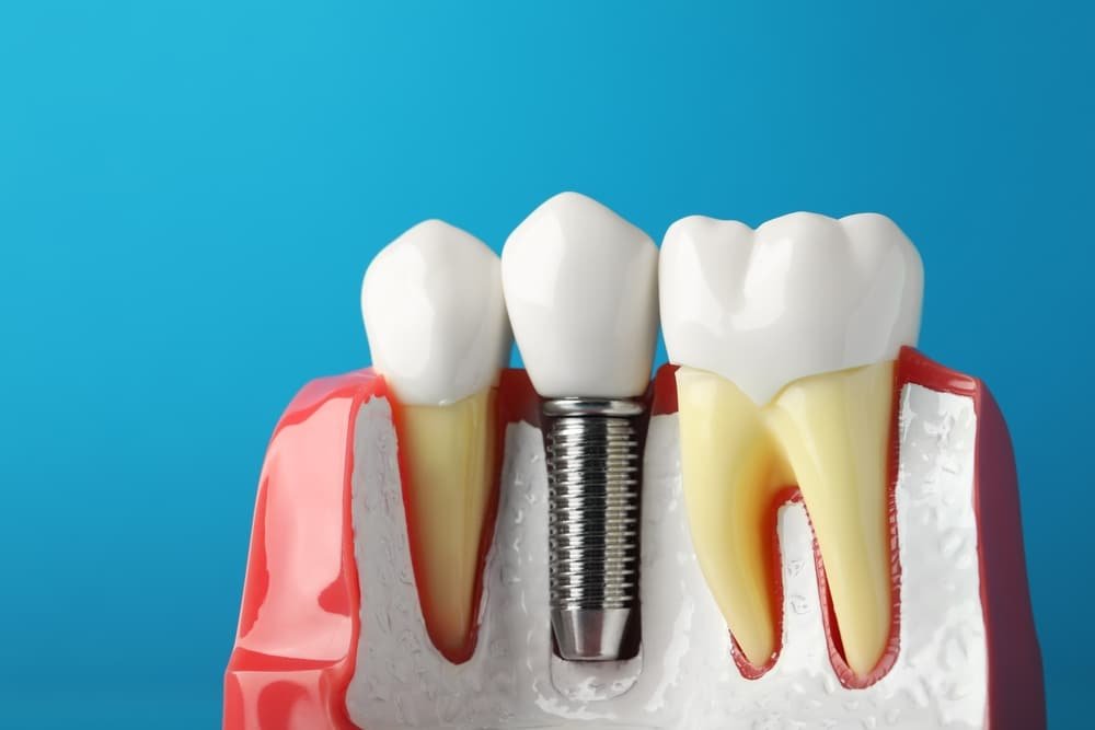Dental Implants
