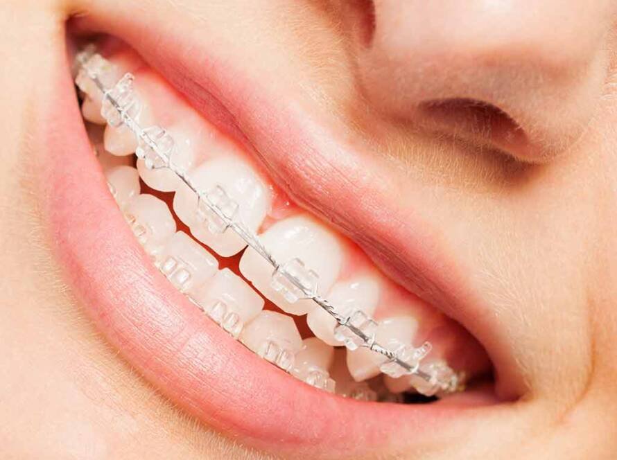 Damon Braces