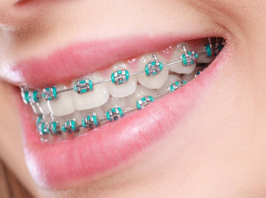 Dental Braces