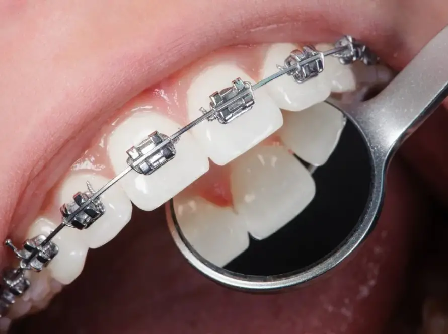 Dental Braces