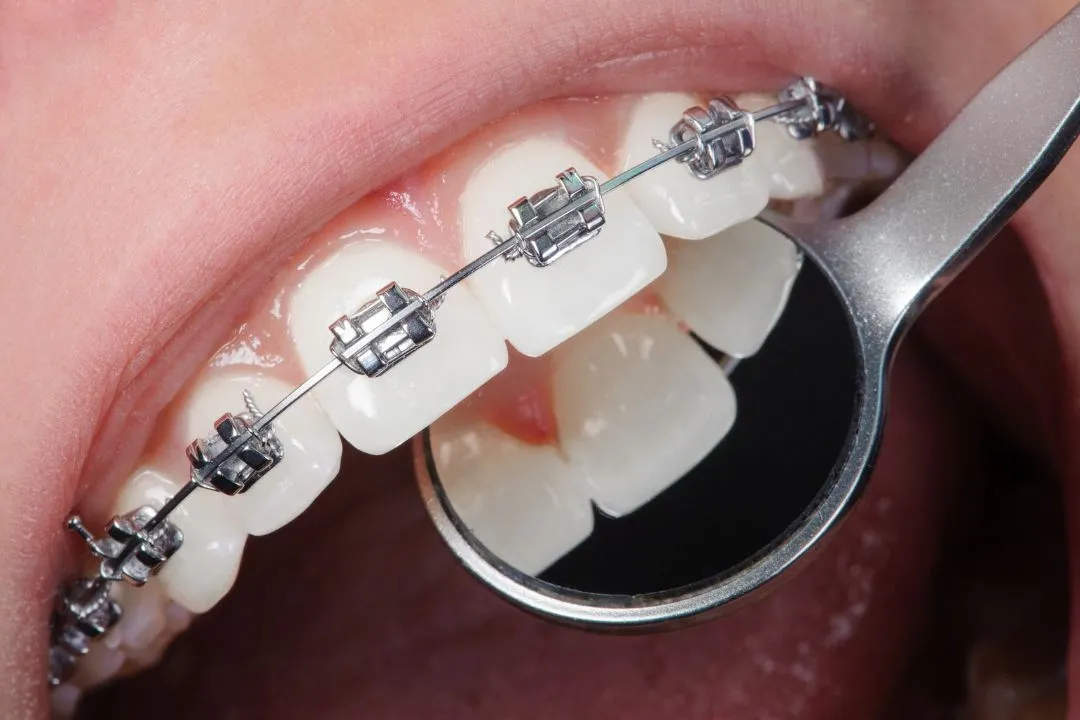 Dental Braces