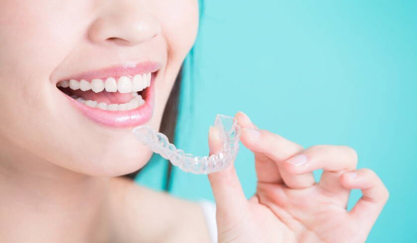 Invisalign Clear Aligners