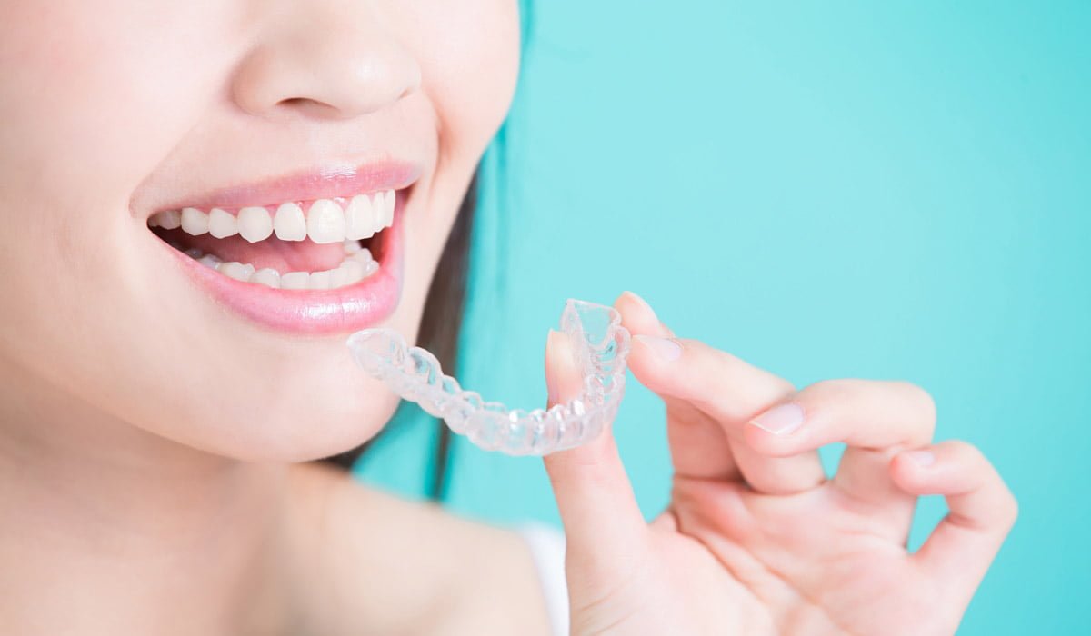 Invisalign Clear Aligners
