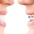 Dental Braces vs Invisalign in Bangalore: Which Is Better for Teens?