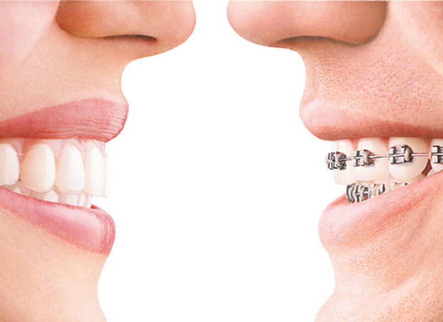 Dental Braces vs Invisalign