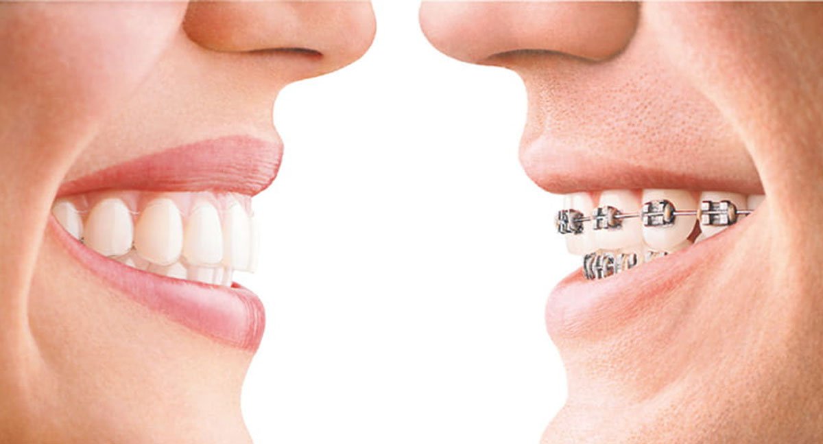 Dental Braces vs Invisalign