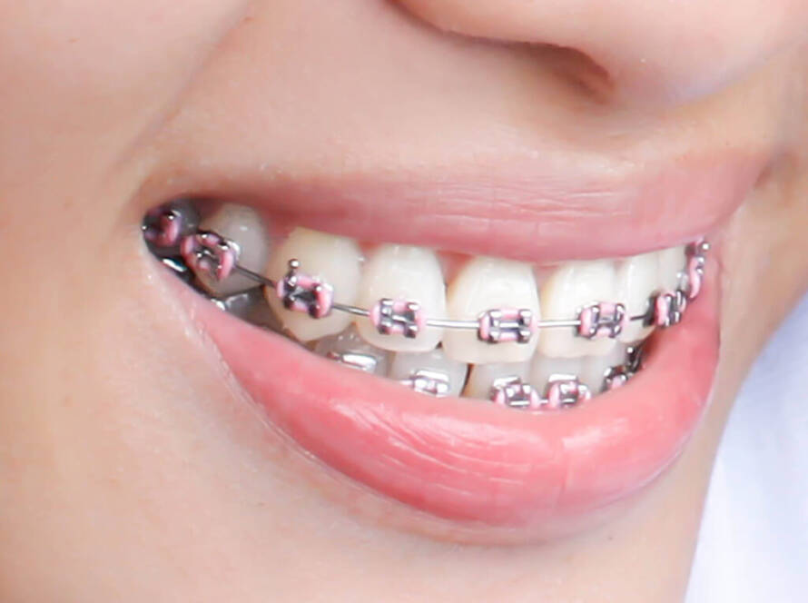 Orthodontist Braces