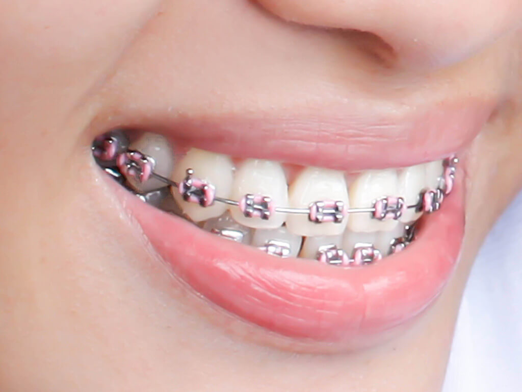 Orthodontist Braces