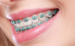 Dental Braces Treatment in Bangalore