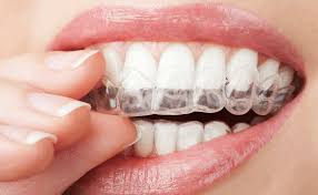 Invisalign Clear Aligners