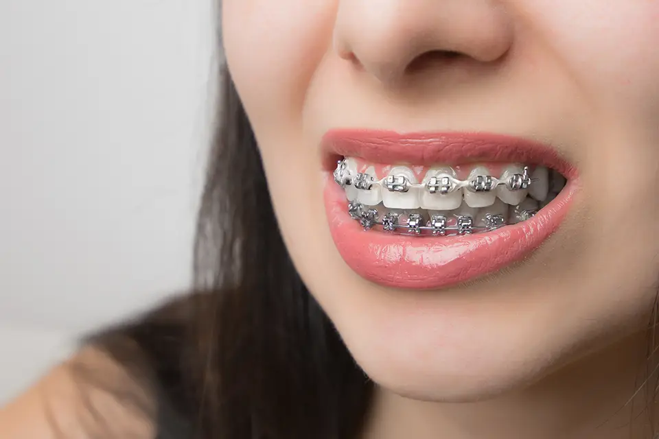 metal braces