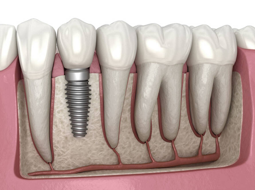 Dental Implant