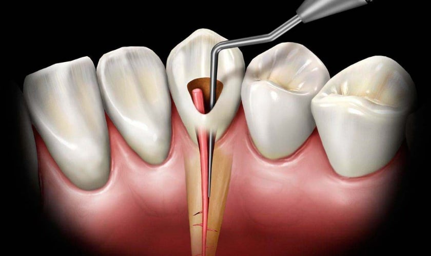 Root Canal Treatment Painful