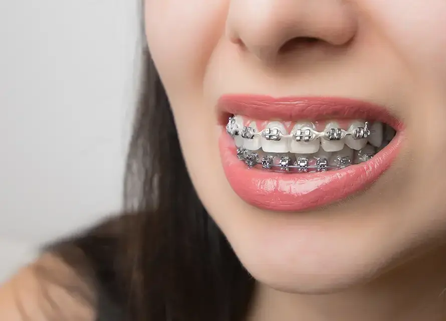 Metal Braces