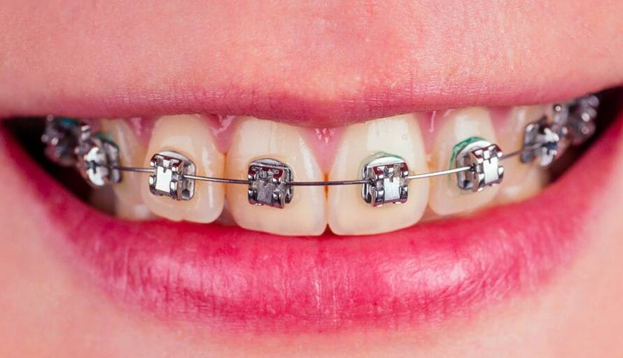 Self-Ligating Braces