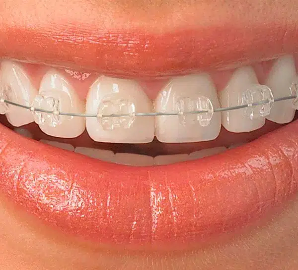 Ceramic Braces
