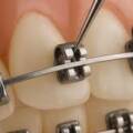 Are Self-Ligating Braces Faster?