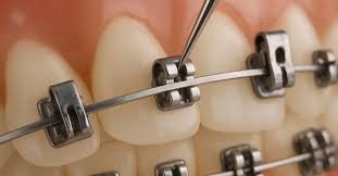 Self-Ligating Braces