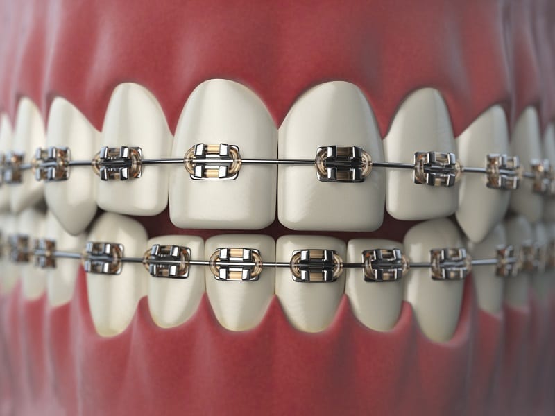 Braces