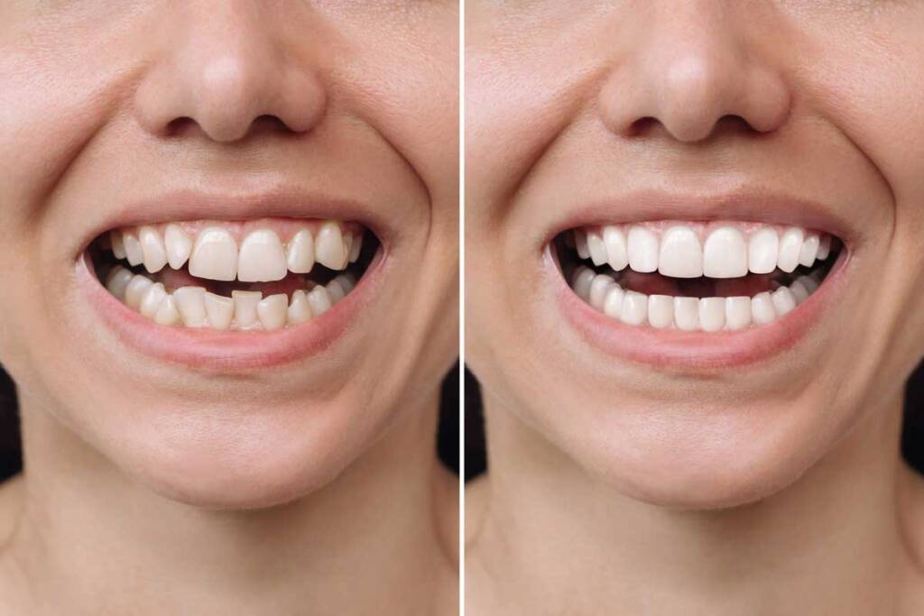 Invisalign
