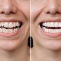 Is Invisalign Painful?